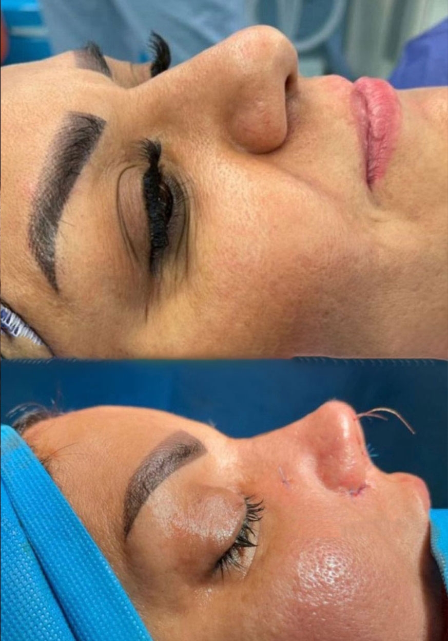 جراحی بینی گوشتی